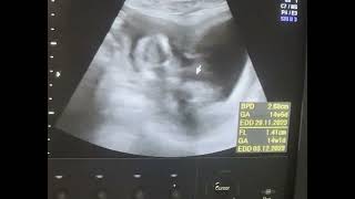 Bicornuate uterus 14wks pregnancy Diagnostic ultrasound cases [upl. by Eidok965]