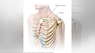 What You Need to Know About Tietze Syndrome  Tita TV [upl. by Onaimad419]