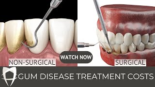 Periodontal disease  Periodontitis  Gingivitis  Treatment Fees [upl. by Ripley371]