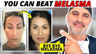 How Dr Amir Karam treated his wifes Melasma AT HOME Step by Step [upl. by Nora]