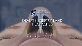 Deviated Septum and Headaches [upl. by Reviel]