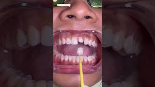 Dental Capping Treatment  Dental Crown Procedure Front Teeth zirconiacrown dentalcrowns shorts [upl. by Noy113]