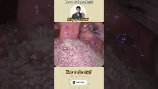 tonsil tonsilstones satisfyingvideo cleaning asmr [upl. by Puff]