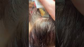 Scalp Treatment for Eczema [upl. by Cheyney]