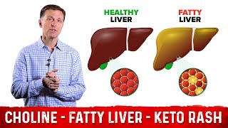 Choline One of The Best Vitamins for Fatty Liver – Dr Berg [upl. by Dinerman]