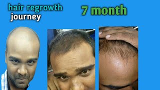 my hair regrowth journey 7 months balayam yoga nail rubbing exercise 100 hair growth [upl. by Paddy]