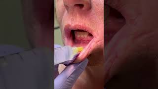 Dental Abscess Incision and Drainage in 60 seconds [upl. by Rahal]