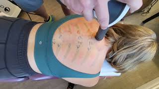 Rib Subluxation Treatment  Rib Pain Treatment  Shockwave  Oakville Chiropractor [upl. by Oruam278]