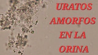 🔥 URATOS AMORFOS EN LA ORINA 🔥 [upl. by Enirehtak890]