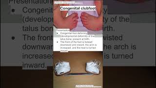 Congenital clubfoot [upl. by Iba]