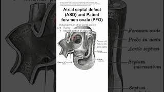 Amplatzer Septal Occluder Large Atrial Septal Defect [upl. by Reichert]