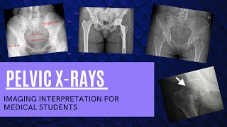 Pelvic XRays for Medical Students [upl. by Necaj]