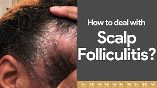 Dealing with Scalp Folliculitis Watch immediately [upl. by Lepp]