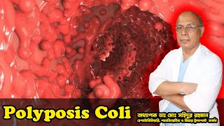 Polyposis Coli । কোলনে অসংখ্য পলিপ । অধ্যাপক ডাঃ মোঃ সহিদুর রহমান।LGSH [upl. by Jeniffer]