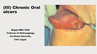 III Chronic Oral Ulcers [upl. by Cora]