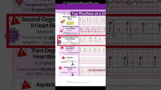 ECG EKG Rhythms to Know Sinus Rhythms Sinus Tachycardia Heart blocks etc [upl. by Rudich116]