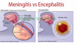 Encephalitis  Encephalopathies  दिमाग में पानी भरना कारण एंव उपचारHindi [upl. by Nue]