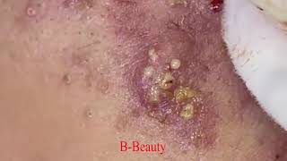 Pimple Removal and Acnes Treatment  BBeauty 07 [upl. by Hewitt]