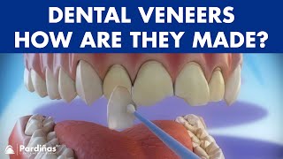 Veneers  How are they made Preparation and placement of cosmetic dentistry veneers © [upl. by Vieva]