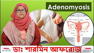 Adenomyosis  অ্যাডেনোমায়োসিস  নারী স্বাস্থ্য  Best homeopathic doctor in Bangladesh [upl. by Cyler612]