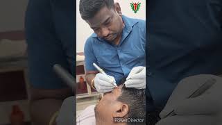 How to Remove Moles Using A Laser  Dr Sanjeeb Rout dentalclinic lasertreatment shorts [upl. by Hy]