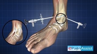 Ankle ArthroscopyDiagnostic Procedure [upl. by Nnylylloh]