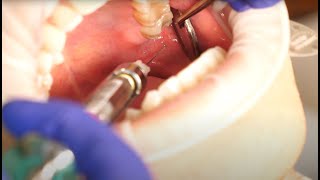 Inferior Alveolar Nerve Block Demonstration and Overview 4K [upl. by Ellerad]