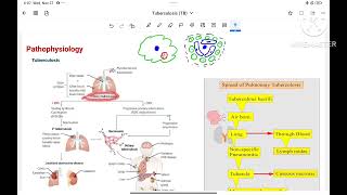 Tuberculosis pathophysiology  investigation amp treatment [upl. by Sillaw]