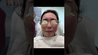 Miracu PDO thread Face Lift Treatment by Dr Tsay  Ageless MD [upl. by Aneertak]