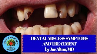 Dental Abscess Symptoms and Treatment in Survival [upl. by Aila]