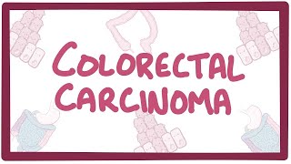 Colorectal carcinoma  causes symptoms diagnosis treatment pathology [upl. by Jowett]