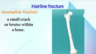 Types Of Fractures  Bone  Orthopedic  orthopedics ms fcps doctor fracture [upl. by Llertram782]