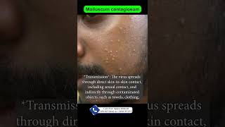 Molluscum contagiosum  मॉल्यूसम क्या है  चेहरे में सफ़ेद दान का इलाज  Dr Uttam Kumar Lenka [upl. by Pudens]