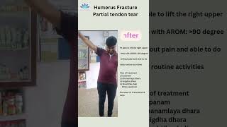 Ligament tear Patient testimonial DrLRakesh MD Panchakarma [upl. by Chariot]