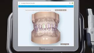 iTero™ scanner tutorial Invisalign® Outcome Simulator [upl. by Eseryt373]