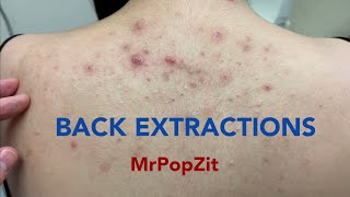 Tons of blackheads on the back Acne extractions Blackheads and whiteheads Mining pore dirt [upl. by Rotceh]