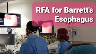 RFA for Barretts Esophagus \\ BARRX RFA System Basic Preparation [upl. by Noeruat]