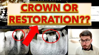 Treatment Planning PRACTICE Dental Crown vs Restoration caries removal ICDAS full cases OPG [upl. by Holmann981]