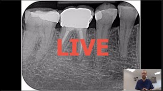 Commentaires LIVE  Retraitement endodontique  46 couronne tenons fibrés condensation verticale [upl. by Erreip]