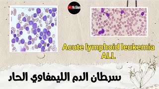 سرطان الدم الليمفاوي الحاد 🔥 Acute lymphoblastic leukemia بالتفصيل ALL [upl. by Philomena421]