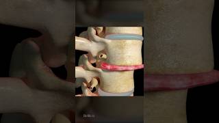 Intervertebral Disc Replacement 3D Animation [upl. by Khorma]