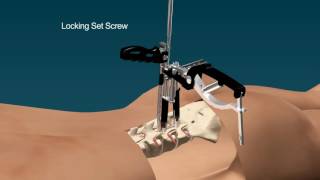 AnyPlus MIS Percutaneous Pedicle Screw System [upl. by Dlonra]