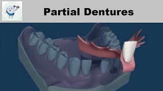 Removable Partial Dentures [upl. by Anoyi]