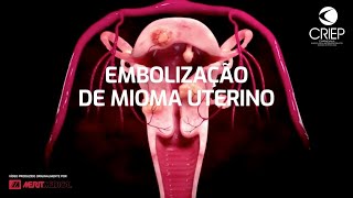 Embolização de Mioma Uterino [upl. by Klute279]