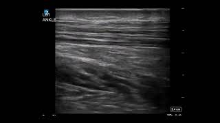 Ankle Ultrasound Achilles Tendonitis With Enthesophyte [upl. by Aztin]