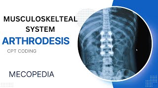 Arthrodesis CPT coding I Musculoskeletal System CPT Malayalam Explanation I CPT Malayalam I [upl. by Aerdnaid]