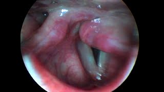 Unilateral Left Vocal Cord Paralysis [upl. by Trinia]