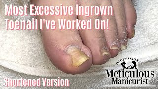 Most Extreme Ingrown Toenail Salon Pedicure  Shortened [upl. by Roxie]