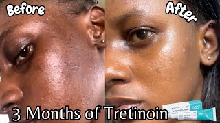 3 Months Tretinoin before and after  Tretinoin on black skin [upl. by Suoicul377]