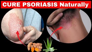 Psoriasis TREATMENT in 30 Days with These Simple natural Remedies [upl. by Silver]